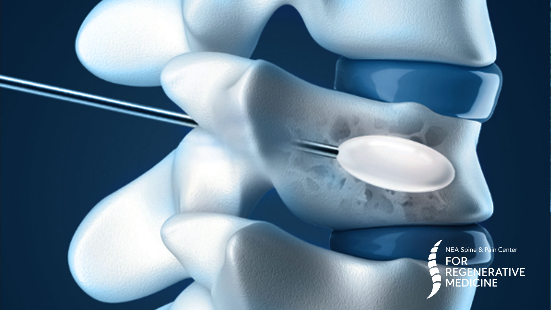 Radiofrequency Ablation (RFA)